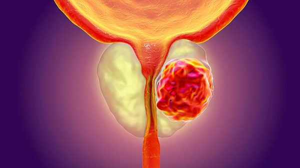 Typical symptoms that might signal acute spinal cord compression include weakness in the legs and difficulty walking Symptoms of prostate cancer
